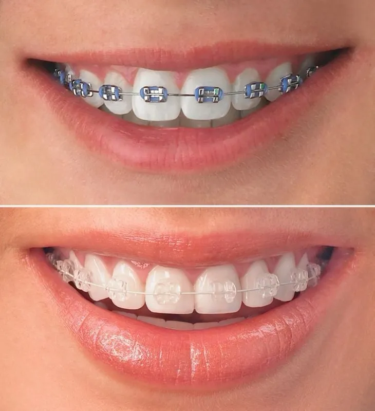 Brackets